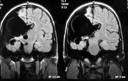 schizencephaly